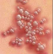 Illustration for article titled lidah buaya sebagai obat herpes